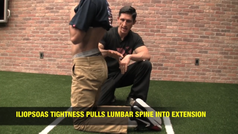 tight iliopsoas pulls lumbar spine into extension