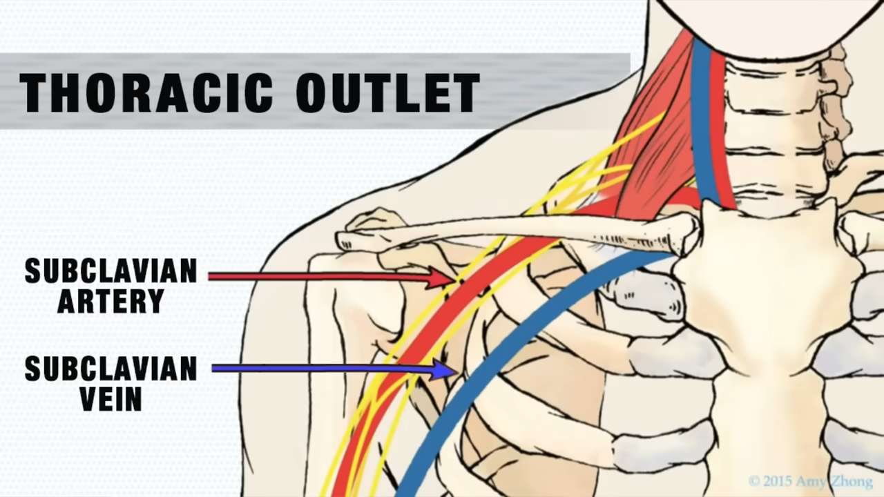 thoracic outlet injury