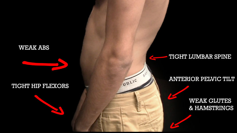 weakness and imbalances caused by anterior pelvic tilt